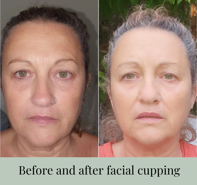 before and after facial cupping
